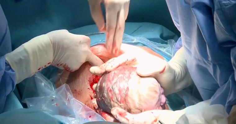 Okładka artykułu Cesarskie cięcie na rządanie, czyli jak idąc na skróty wydłużamy sobie drogę.